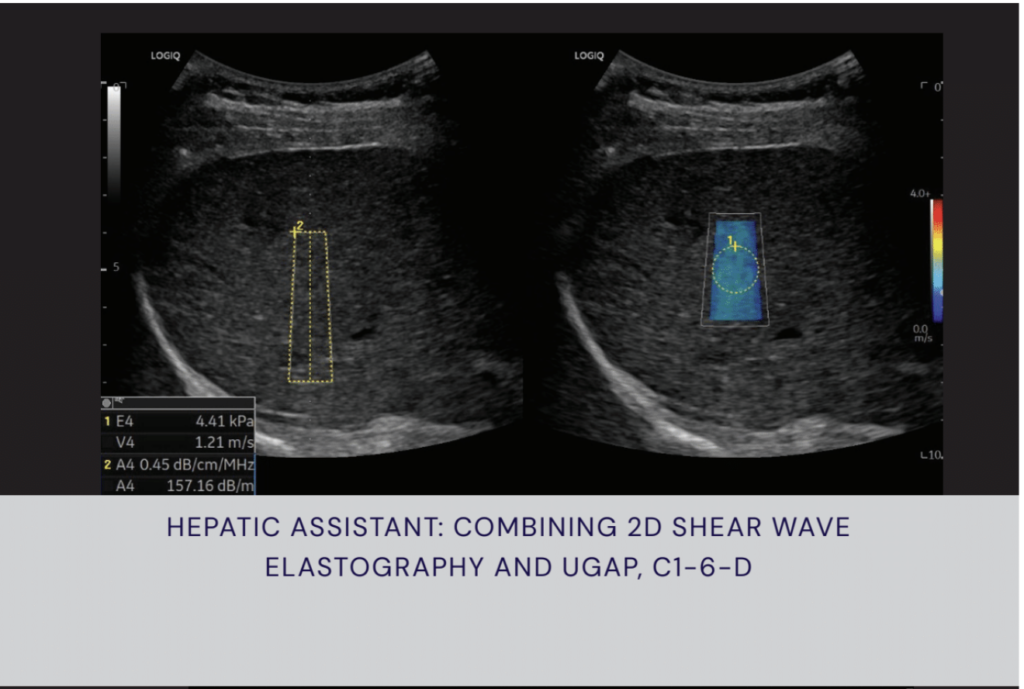 LOGIQ Fortis Hepatic Assistant